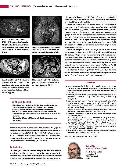 Vorschauseite 3: Anomalien und Normvarianten – Interne Veränderungen 2. 29: Varianz des venösen Abstroms der Nieren