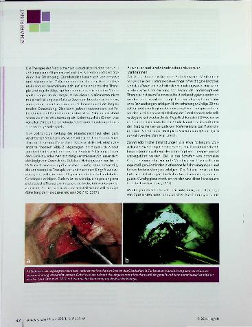 Vorschauseite 3: Medikamentenassoziierte Kiefernekrose