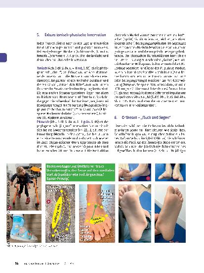 Vorschauseite 6: Infantile Zerebralparese (ICP) mit kombinierter, umschriebener Entwicklungsstörung. Ergotherapeutische Behandlung von Lena (5 Jahre).