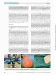 Vorschauseite 3: Karotido-subclavialer Bypass zur Revaskularisation der Arteria subclavia sinistra