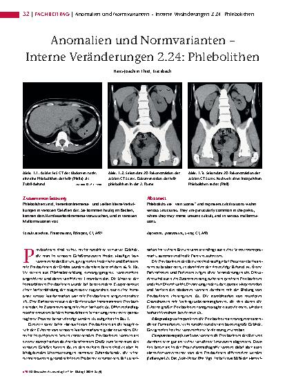 Vorschauseite 1: Anomalien und Normvarianten – Interne Veränderungen 2.24: Phlebolithen