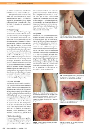 Vorschauseite 2: Update Pyoderma gangraenosum