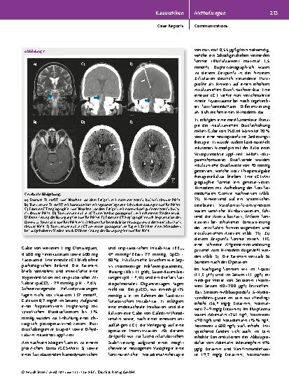 Vorschauseite 3: Postoperatives cerebrales Vasokonstriktionssyndrom nach Implantation eines Ommaya-Reservoirs – Ein Fallbericht
