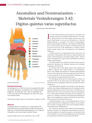 Vorschauseite 1: Anomalien und Normvarianten – Skelettale Veränderungen 3. 42: Digitus quintus varus superductus