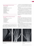 Vorschauseite 2: Anomalien und Normvarianten: Skelettale Veränderungen 3.29: Brachydaktylie und Brachymetacarpie