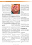 Vorschauseite 3: Rauchen und chronische Wunden