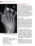Vorschauseite 5: Rheumatoide Arthritis