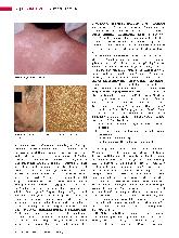Vorschauseite 3: Malassezia-Hefen (Teil 2) Kommensale und Krankheitserreger - eine Übersicht