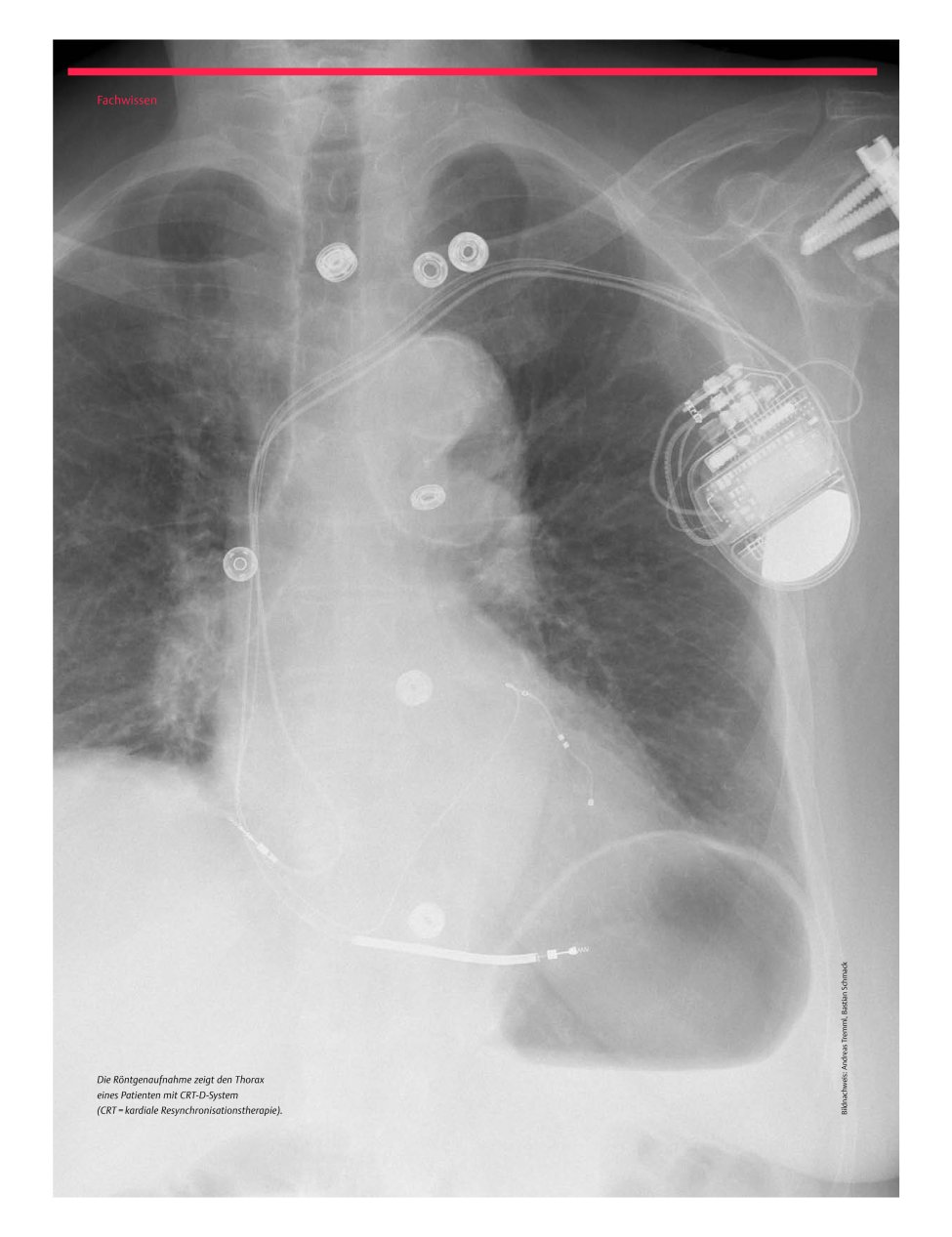 Vorschauseite 1: Therapie von innen? Herzschrittmacher und Defibrillatoren