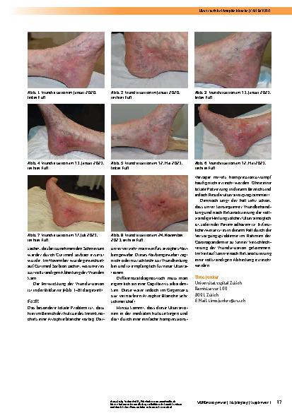Vorschauseite 2: Ulcus cruris bei Atrophie blanche
