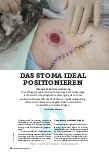 Vorschauseite 1: DAS STOMA IDEAL POSITIONIEREN