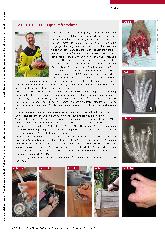 Vorschauseite 4: Innovative prothetische Intervention für Menschen mit Teilhandamputation: Eigenkraftprothesen.