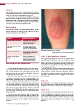 Vorschauseite 3: Lyme-Borreliose Infektion mit variablem Verlauf