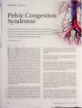 Vorschauseite 1: Pelvic Congestion Syndrom