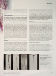 Vorschauseite 2: Pelvic Congestion Syndrom