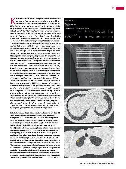 Vorschauseite 2: Update zur Lungenkrebsfrüherkennung mittels Niedrigdosis-Computertomografie (1)