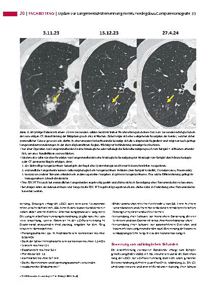 Vorschauseite 5: Update zur Lungenkrebsfrüherkennung mittels Niedrigdosis-Computertomografie (1)