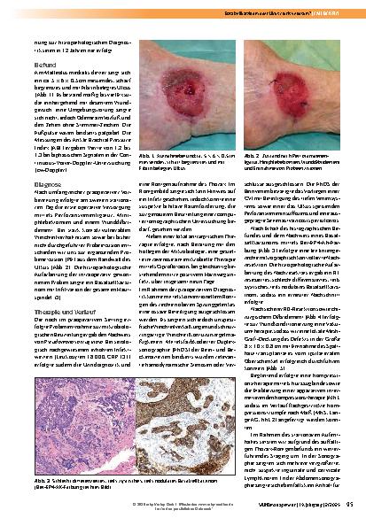 Vorschauseite 2: Basalzellkarzinom oder Ulcus cruris venosum?