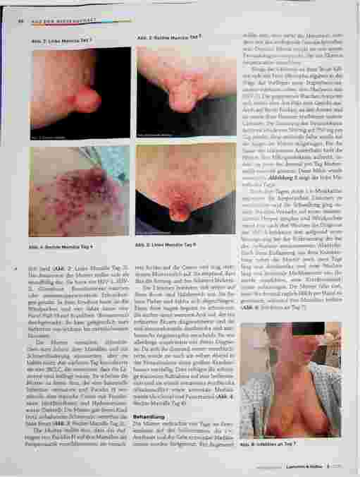 Vorschauseite 2: Schwere HSV-1-Mastitis bei einer stillenden Mutter