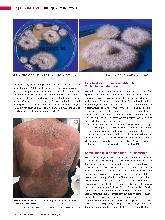 Vorschauseite 3: Trichophyton indotineae Ein multiresistenter Hautpilz breitet sich weltweit aus.