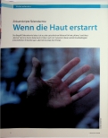 Vorschauseite 1: Zirkumskripte Sklerodermie: Wenn die Haut erstarrt