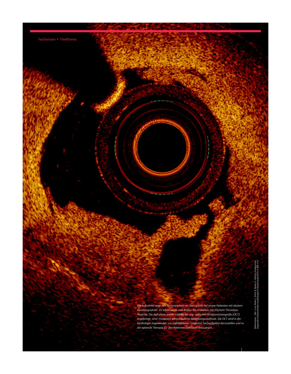 Vorschauseite 1: ERC-Leitlinien 2015 – Akutes Koronarsyndrom