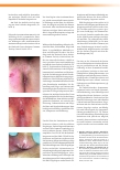 Vorschauseite 5: Dermatologische Reaktionen unter medikamentöser Antitumortherapie