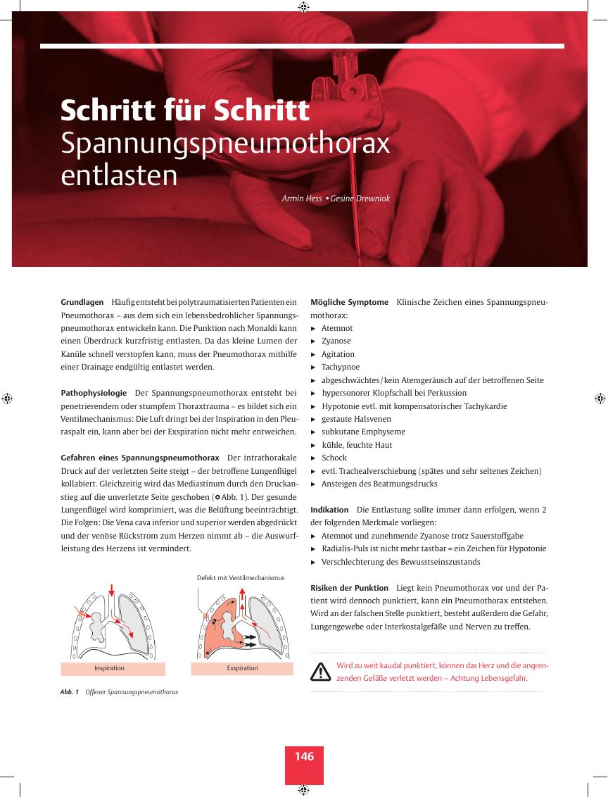 Vorschauseite 1: Schritt für Schritt ? Spannungspneumothorax entlasten