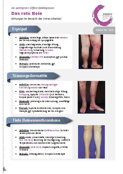 Vorschauseite 2: Stauungsdermatitis