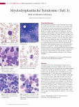 Vorschauseite 1: Myelodysplastische Syndrome (Teil 3) MDS mit Blastenvermehrung