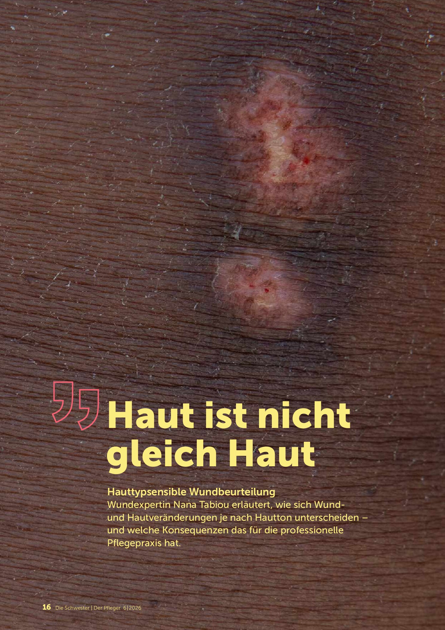 Vorschauseite 1: Haut ist nicht gleich Haut – Hauttypsensible Wundbeurteilung