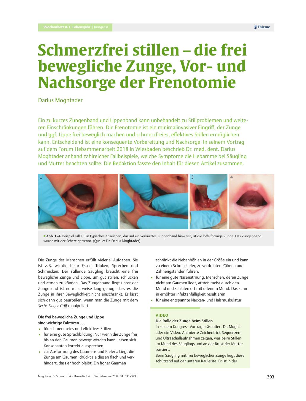 Vorschauseite 1: Schmerzfrei stillen? ?? die frei bewegliche Zunge, Vorund Nachsorge der Frenotomie
