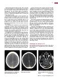 Vorschauseite 2: Die Sinus-/Hirnvenenthrombose in der Schnittbilddiagnostik