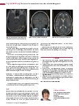 Vorschauseite 5: Die Sinus-/Hirnvenenthrombose in der Schnittbilddiagnostik