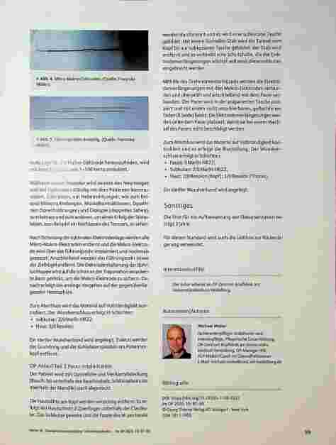 Vorschauseite 3: Standard stereotaktische Tiefenhirnstimulation