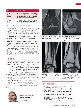 Vorschauseite 2: Anomalien und Normvarianten: Skelettale Veränderungen 3.33 - Nicht ossifizierendes Fibrom