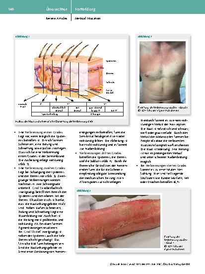 Vorschauseite 3: Vorgehen nach thermischen Verletzungen aus präklinischer, intensiv medizinischer und chirurgischer Sicht