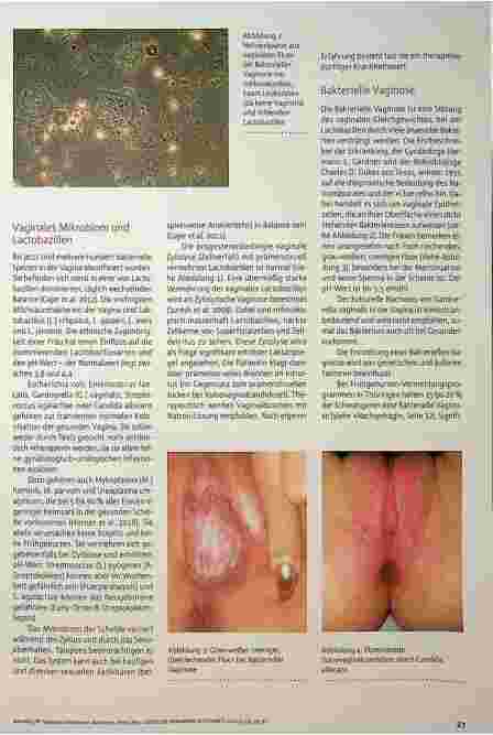 Vorschauseite 2: Vaginale Infektionen: Bakterien, Viren, Pilze