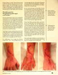 Vorschauseite 3: Mesotherapie bei Hauterkrankungen und Narben