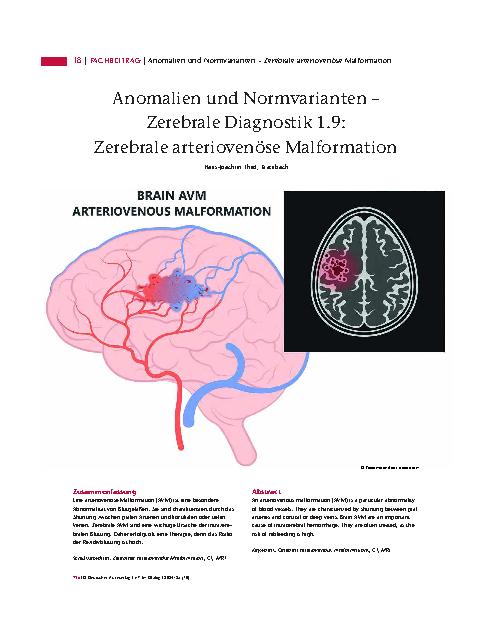 Vorschauseite 1: Anomalien und Normvarianten – Zerebrale Diagnostik 1. 9: Zerebrale arteriovenöse Malformation