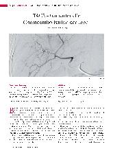 Vorschauseite 1: TACE - transarterielle Chemoembolisation der Leber