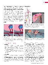 Vorschauseite 4: TACE - transarterielle Chemoembolisation der Leber