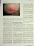 Vorschauseite 3: Diagnose und Behandlung einer Soorinfektion in der Stillzeit