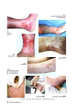 Vorschauseite 1: ULCUS CRURIS VENOSUM ERFOLGREICH VERSORGEN