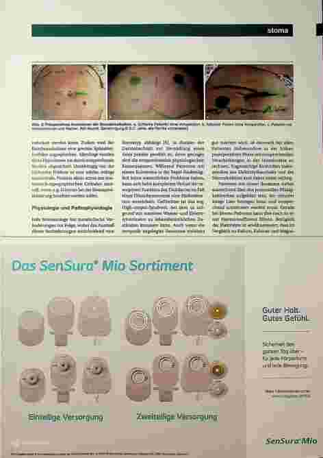 Vorschauseite 2: Eine körperliche und psychische Dimension Vorbereitung zur Stomaanlage, Patientenedukation und Nachsorge.