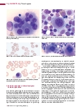 Vorschauseite 3: Thrombopoese (Teil 4) Erworbene Thrombozytopenien