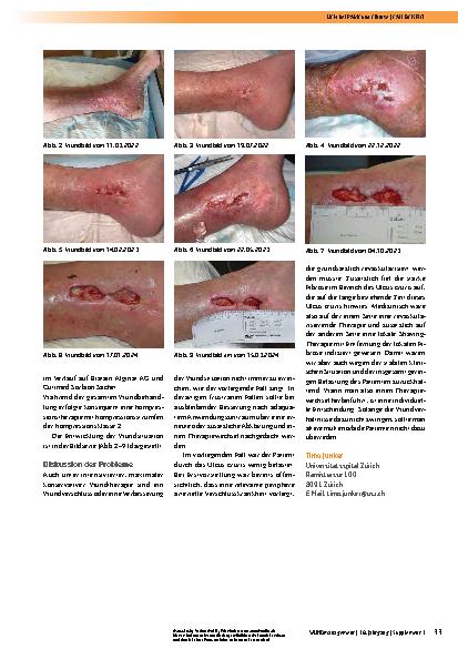 Vorschauseite 2: Ulcus cruris mixtum bei peripherer arterieller Verschlusskrankheit und fortgeschrittener Fibrose