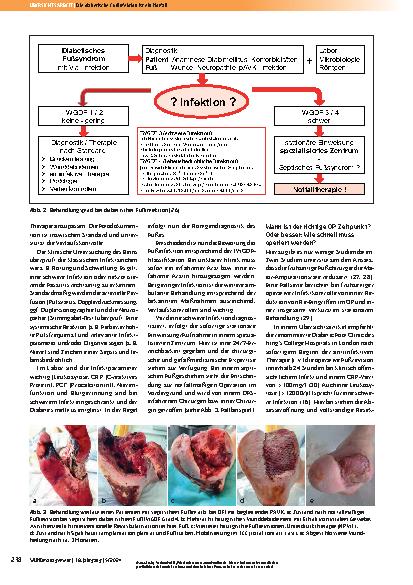 Vorschauseite 5: Die diabetische Fußinfektion ist ein Notfall.