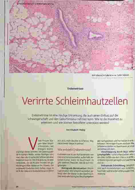Vorschauseite 1: Endometriose: Verirrte Schleimhautzellen