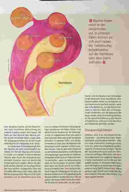 Vorschauseite 2: Schwanger trotz Myom?